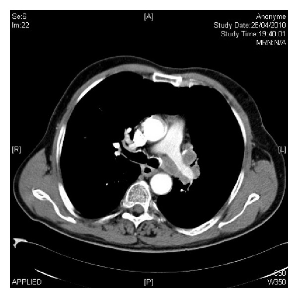 TC de tórax axial com contraste: massa hilar esquerda com linfadenopatia hilar e mediastinal ipsilateral (carcinoma pulmonar de pequenas células). Case courtesy of Laroumagne S, Elharrar X, Coiffard B, Plojoux J, Dutau H, Breen D, Astoul P. Case Rep Med 2014;2014:545490.