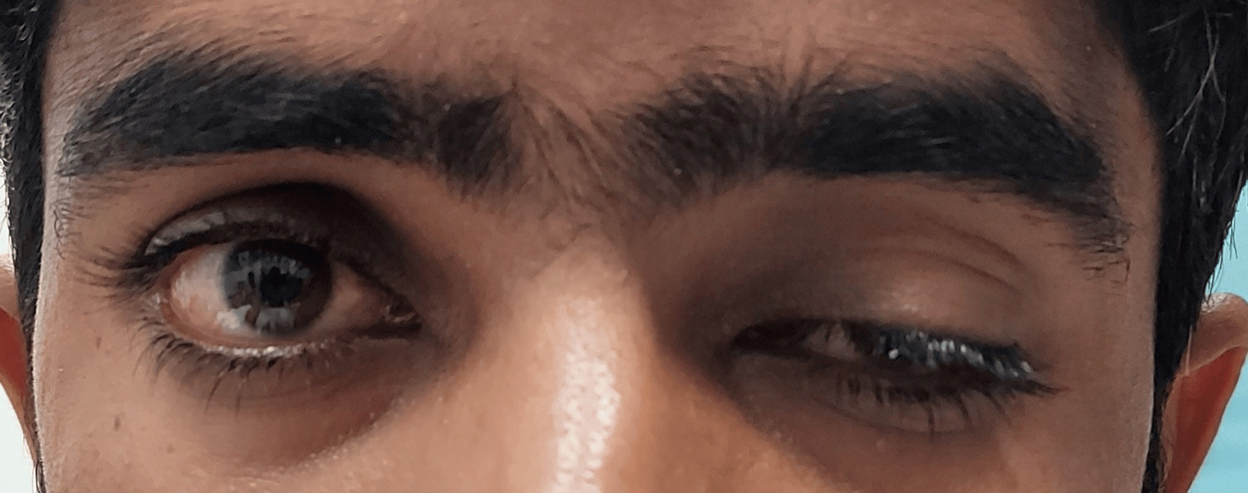 Fotografia clínica: ptose grave à esquerda em olhar primário em adulto jovem (18 a) com miastenia gravis ocular isolada soropositiva (anti-AChR+). Khan TA et al., Cureus 2024;16(7):e66885, Fig. 1.