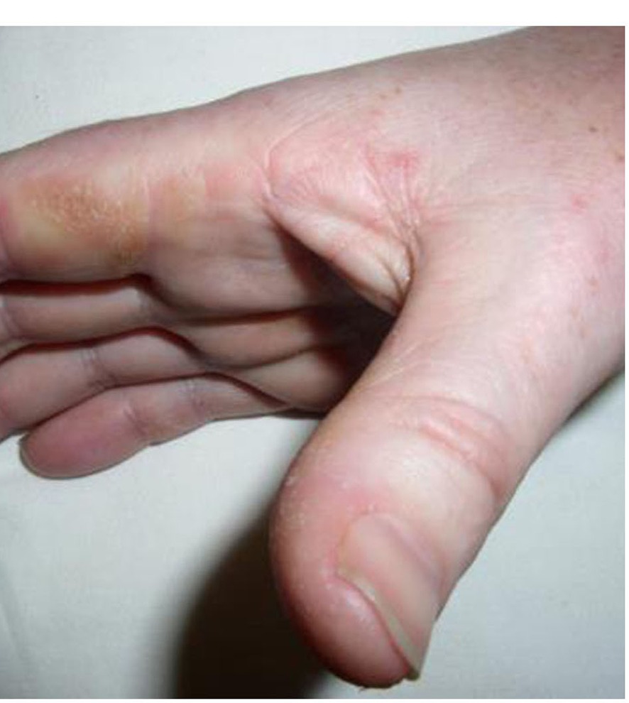 Fotografia clínica da mão com pele hiperceratótica e fissurada na borda radial do indicador e dorso distal — mãos de mecânico