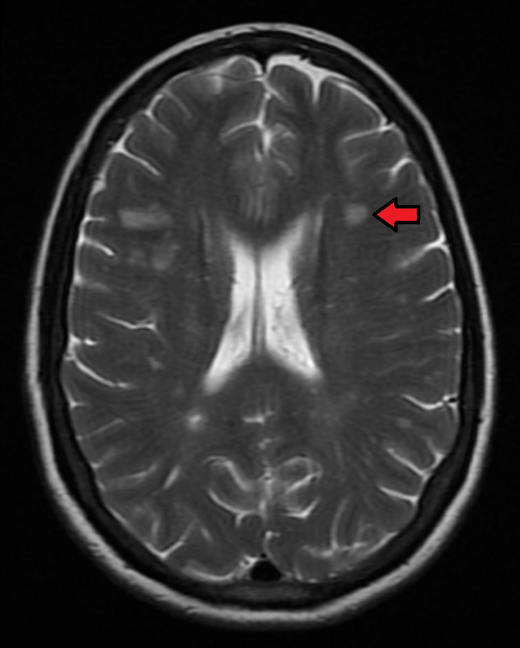 Ressonância magnética axial de encéfalo em ponderação T2 mostrando hiperintensidades de substância branca periventriculares e juxta-corticais típicas de esclerose múltipla; seta vermelha aponta uma lesão.