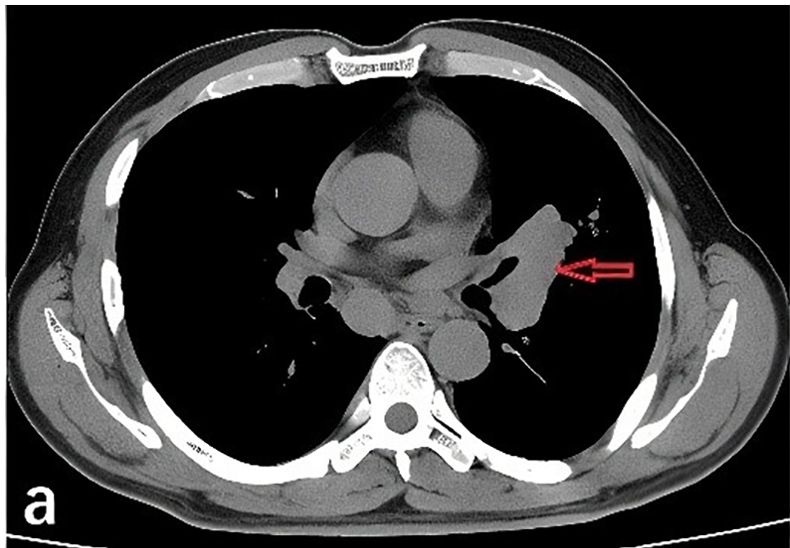 Tomografia computadorizada de tórax em corte axial mostrando massa de partes moles no hilo pulmonar esquerdo com linfadenopatia hilar e mediastinal; seta vermelha aponta a lesão hilar esquerda em caso de carcinoma pulmonar de pequenas células