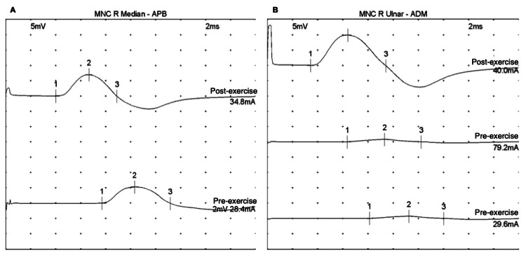 Traçados de potencial de ação muscular composto (CMAP) em LEMS pré-tratamento: painel A (mediano–APB) e painel B (ulnar–ADM) com amplitude baixa em repouso e aumento marcado após 10 segundos de esforço máximo (facilitação pós-exercício / potencial incremental)