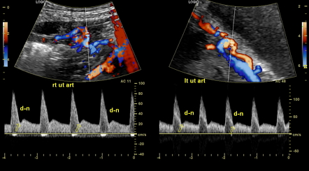 Doppler das artérias uterinas direita e esquerda com incisura diastólica persistente bilateral.