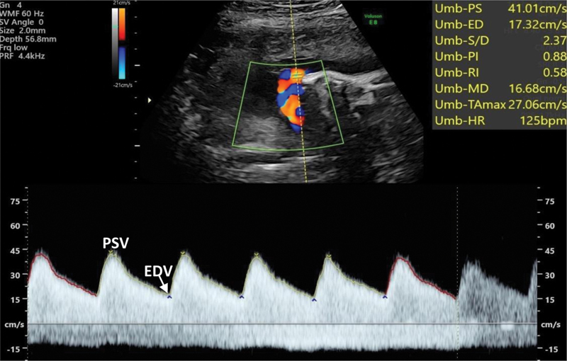 Doppler normal da artéria umbilical com sístole e diástole cheia, vaso de baixa resistência.
