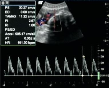 Doppler da artéria umbilical com diástole zero, onda ausente, e diástole reversa, abaixo da linha zero.