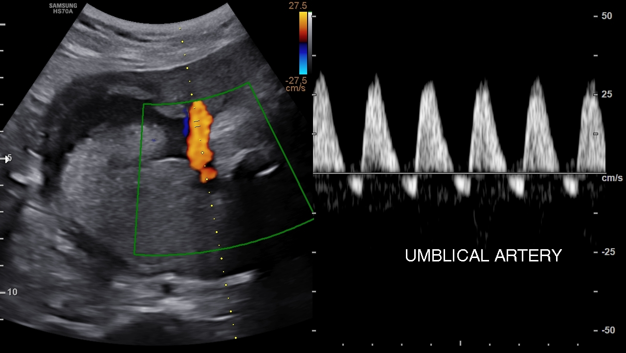 Doppler da artéria umbilical com diástole zero, onda ausente, e diástole reversa, abaixo da linha zero.