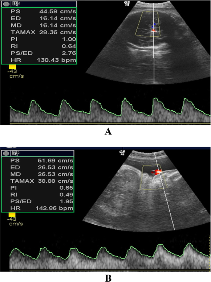 Doppler obstétrico em tela dividida da umbilical e da cerebral média com as relações sístole/diástole em evidência.