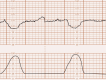 Cardiotocografia com desacelerações da frequência cardíaca fetal a cada contração e retorno à linha de base.