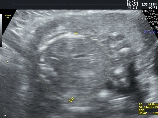 Ultrassonografia com a circunferência abdominal reduzida e a cefálica preservada, padrão de restrição assimétrica.