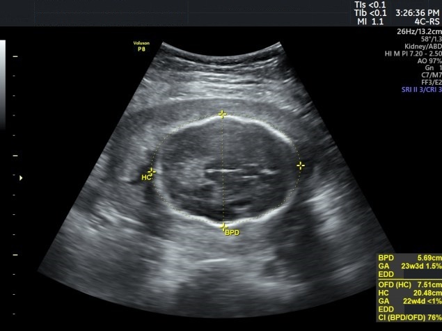 Ultrassonografia com a circunferência abdominal reduzida e a cefálica preservada, padrão de restrição assimétrica.