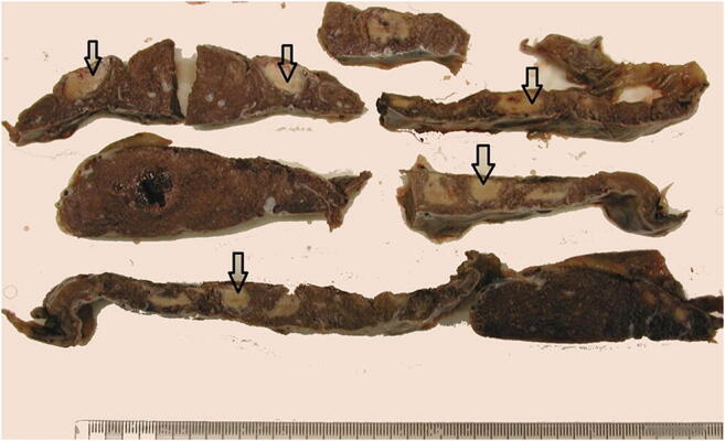 Placenta seccionada com áreas de infarto e insuficiência placentária em exame macroscópico.