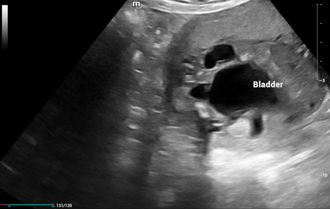 Ultrassonografia obstétrica com megabexiga e sinal em fechadura da válvula de uretra posterior, causa obstrutiva de oligodrâmnio.