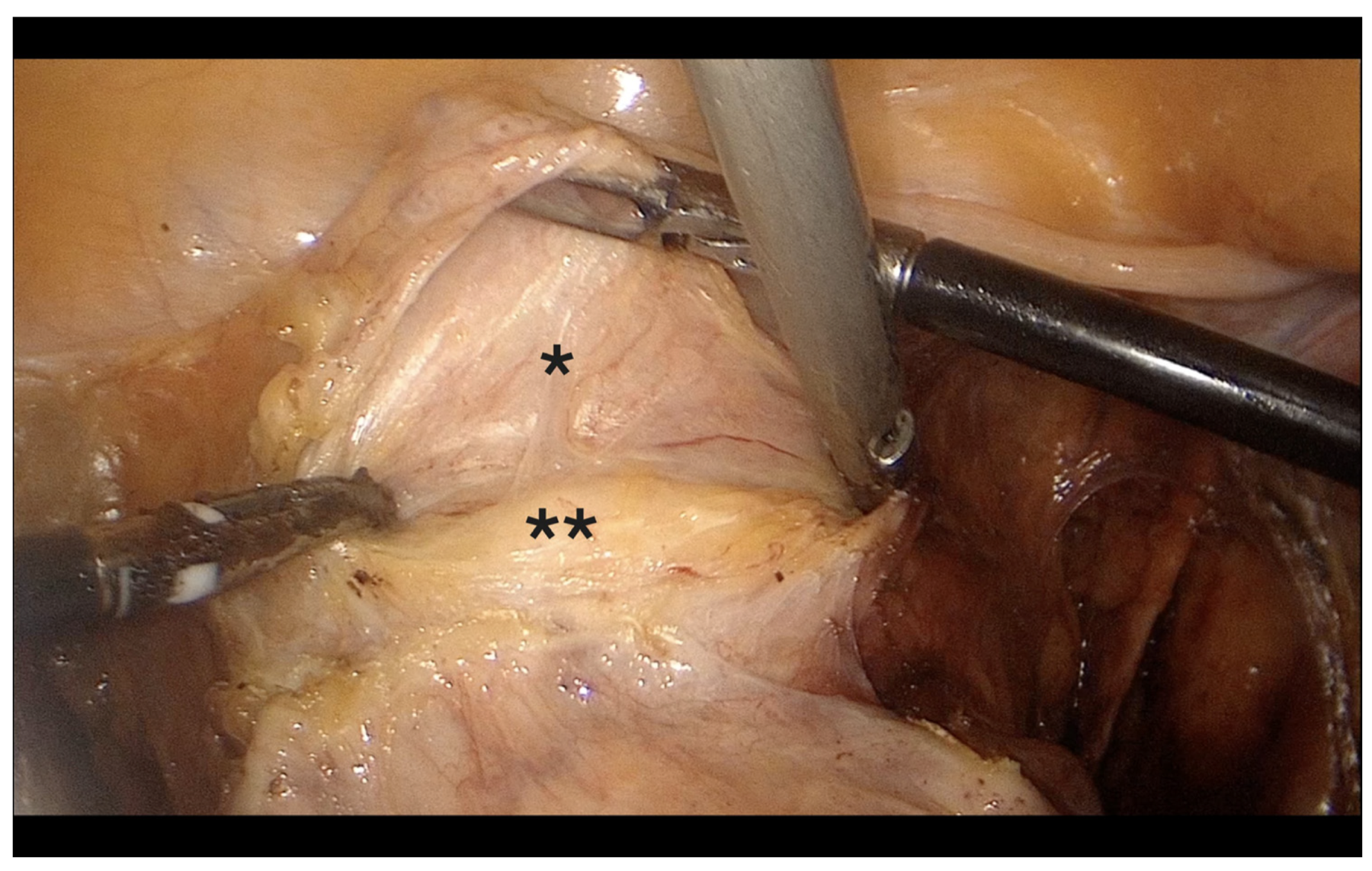 Campo laparoscópico mostrando a bexiga, marcada por um asterisco, elevada acima da parede vaginal anterior, marcada por dois asteriscos; entre ambas aparece o plano conjuntivo vesicovaginal, com o manipulador visível atrás da parede vaginal no fórnice anterior.