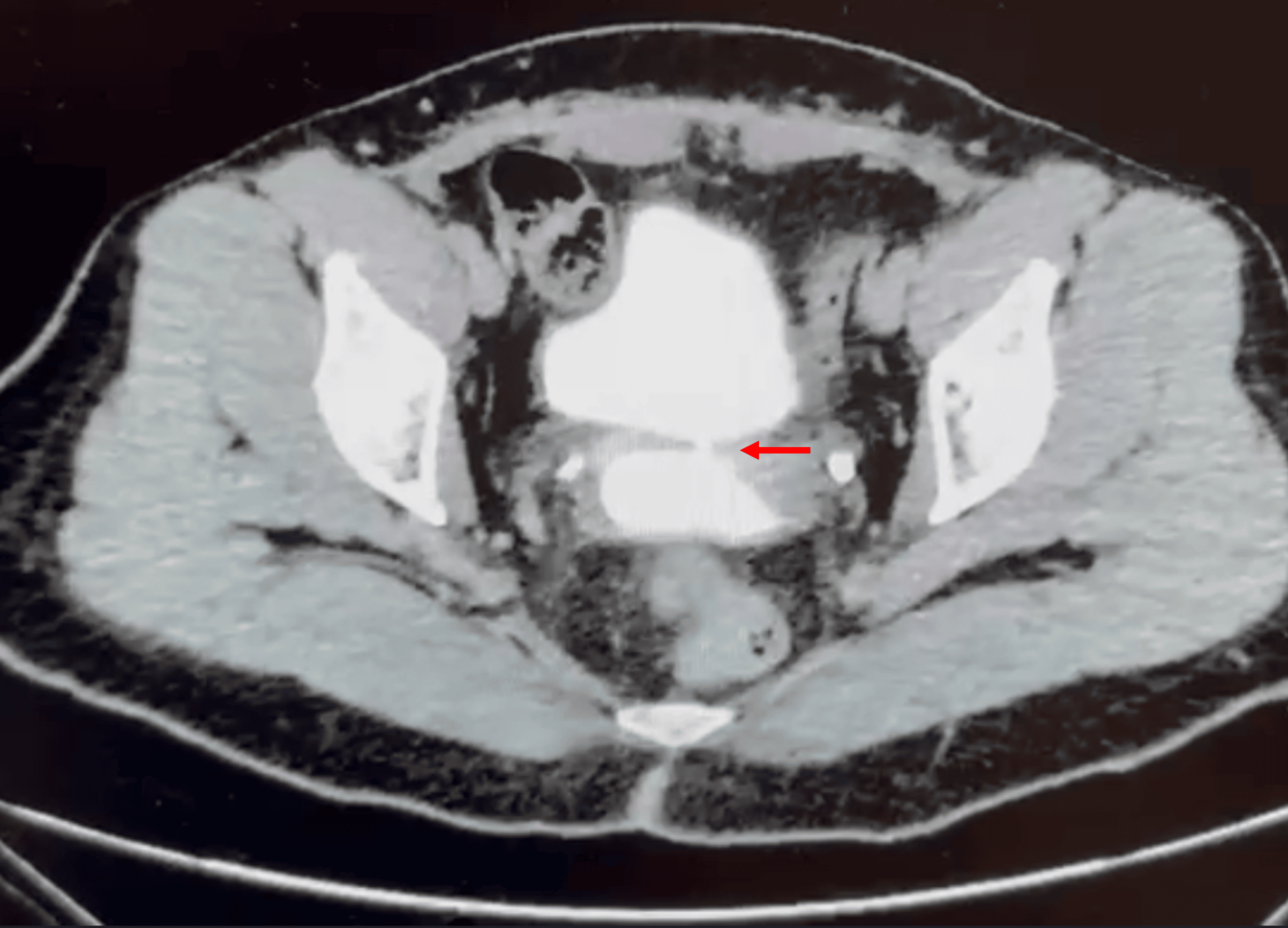 TC axial da pelve com bexiga e vagina opacificadas; seta vermelha aponta o fino trajeto fistuloso que atravessa a parede entre ambas.