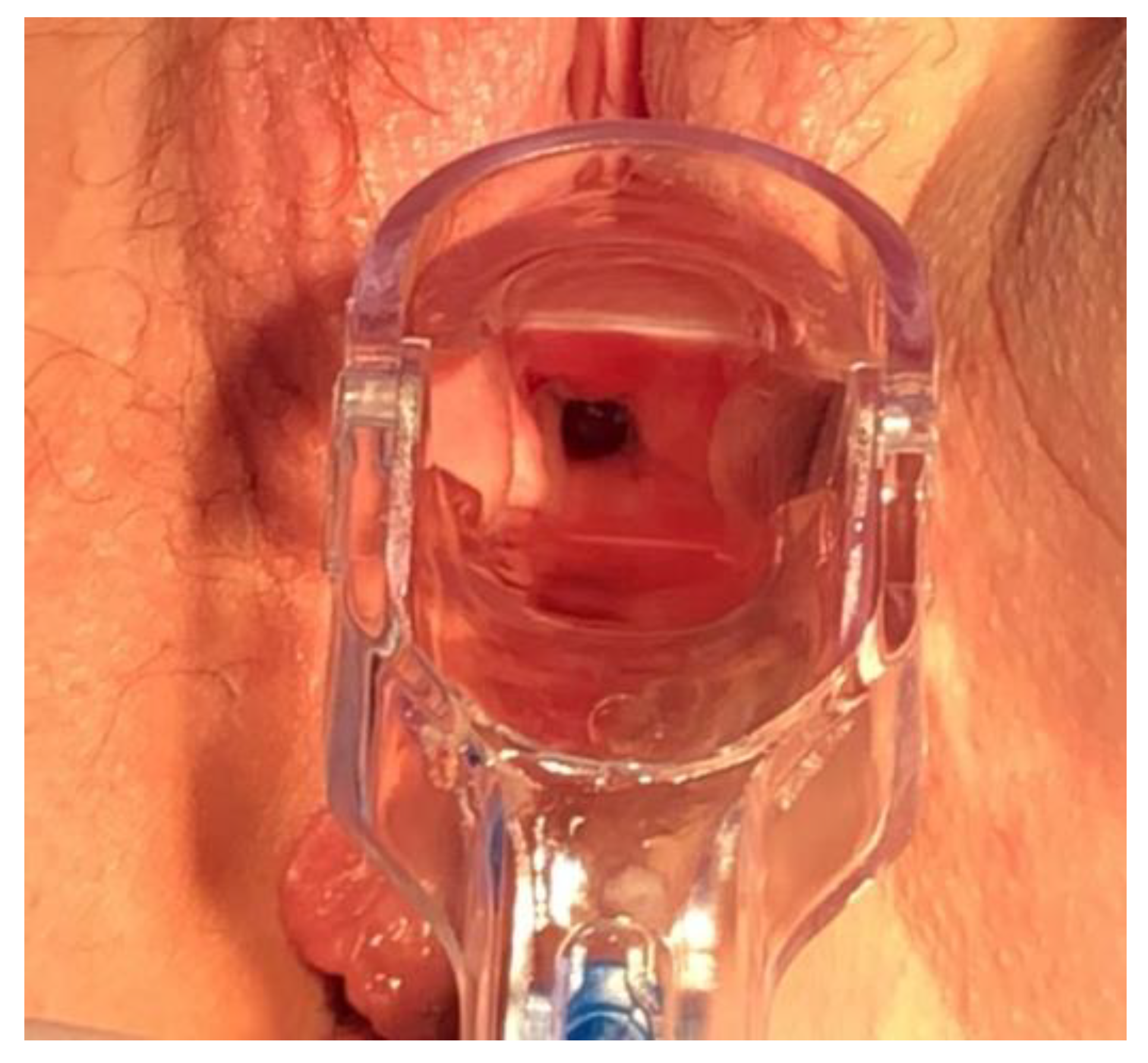Fotografia clínica em campo especular mostrando pequeno orifício fistuloso escuro na cúpula vaginal direita, sem elementos identificadores da paciente.