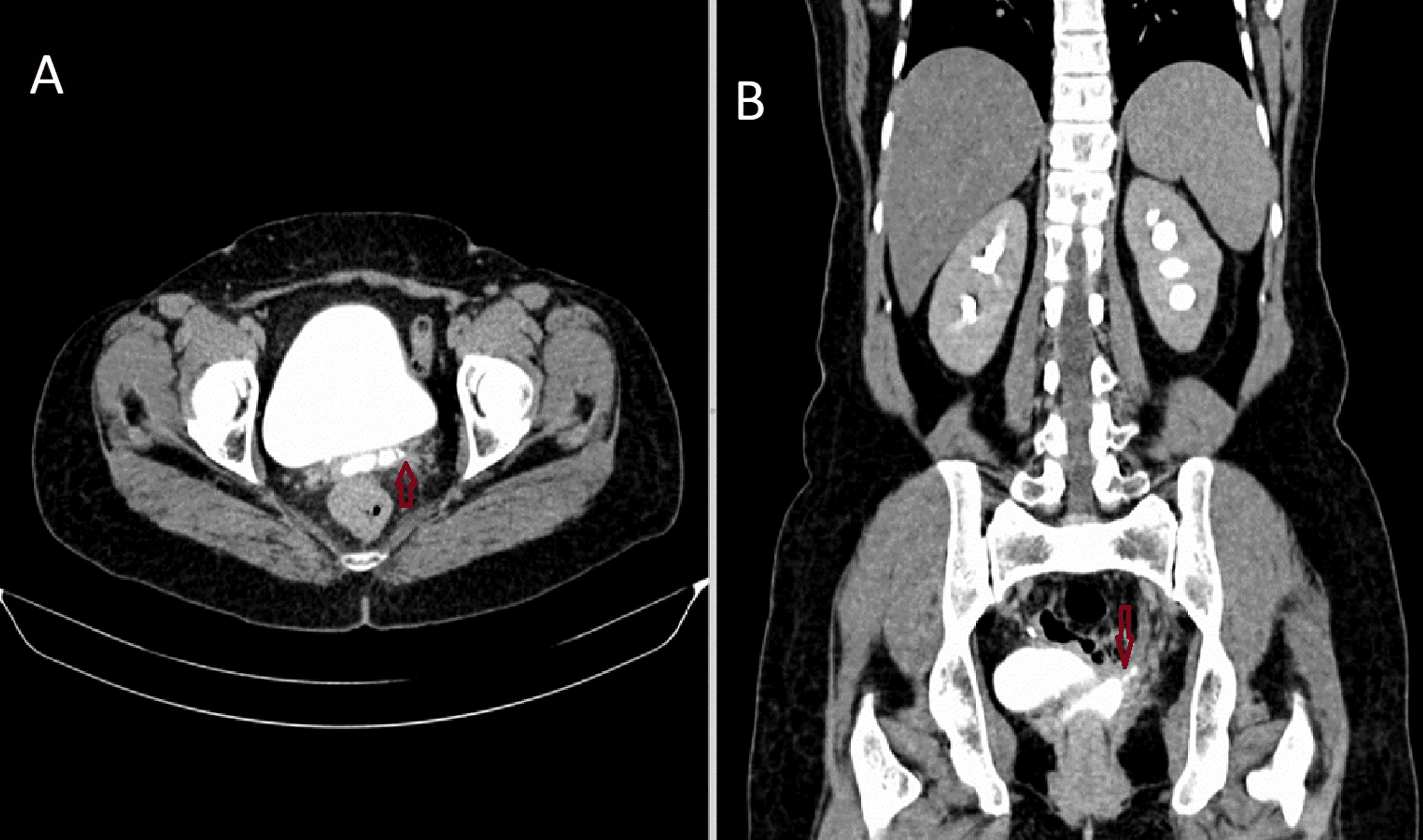 Uro-TC em dois cortes. No corte axial da pelve, bexiga preenchida por contraste e seta vermelha sobre um pequeno foco de contraste posterior a ela, no coto vaginal. No corte coronal, seta vermelha sobre a faixa linear de contraste que desce do ureter esquerdo até o coto vaginal.