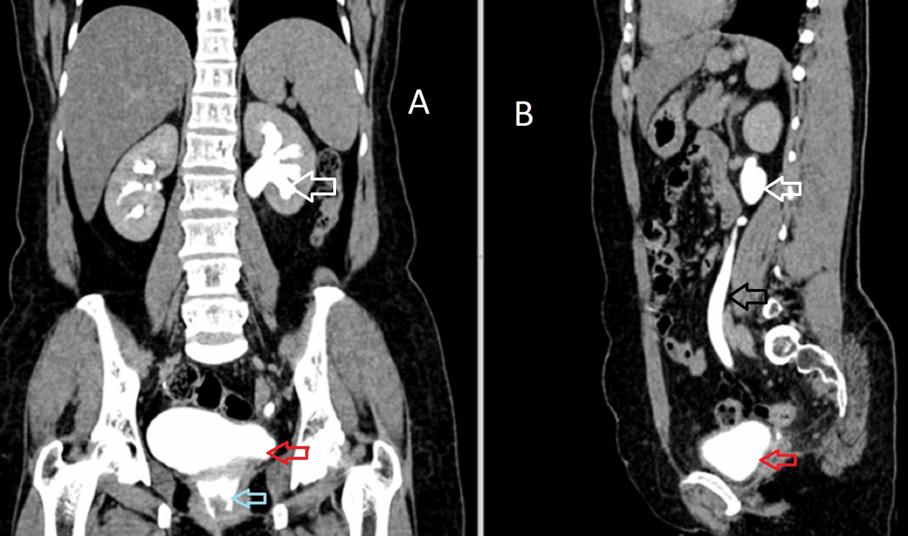 Uro-TC em fase excretora tardia, dois painéis. No painel coronal, sistema pielocalicial esquerdo dilatado e opacificado por contraste (seta branca), bexiga contrastada na pelve (seta vermelha) e foco de contraste caudal à bexiga, no coto vaginal (seta azul). No painel sagital, ureter esquerdo dilatado e cheio de contraste descendo até a pelve (seta preta), com bexiga contrastada abaixo (seta vermelha).