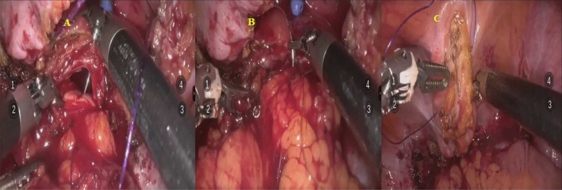 Montagem horizontal de três campos laparoscópicos do reparo de fístula vesicovaginal: sutura da parede vaginal, retalho interposto e fechamento da bexiga.