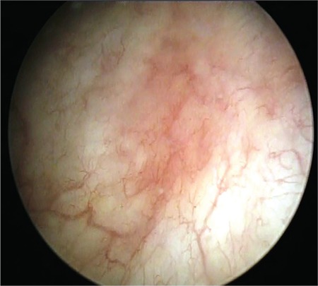 Campo cistoscópico com área eritematosa focal no centro, de configuração estrelada, e pequenos vasos formando raios entre o foco e a mucosa vesical adjacente.