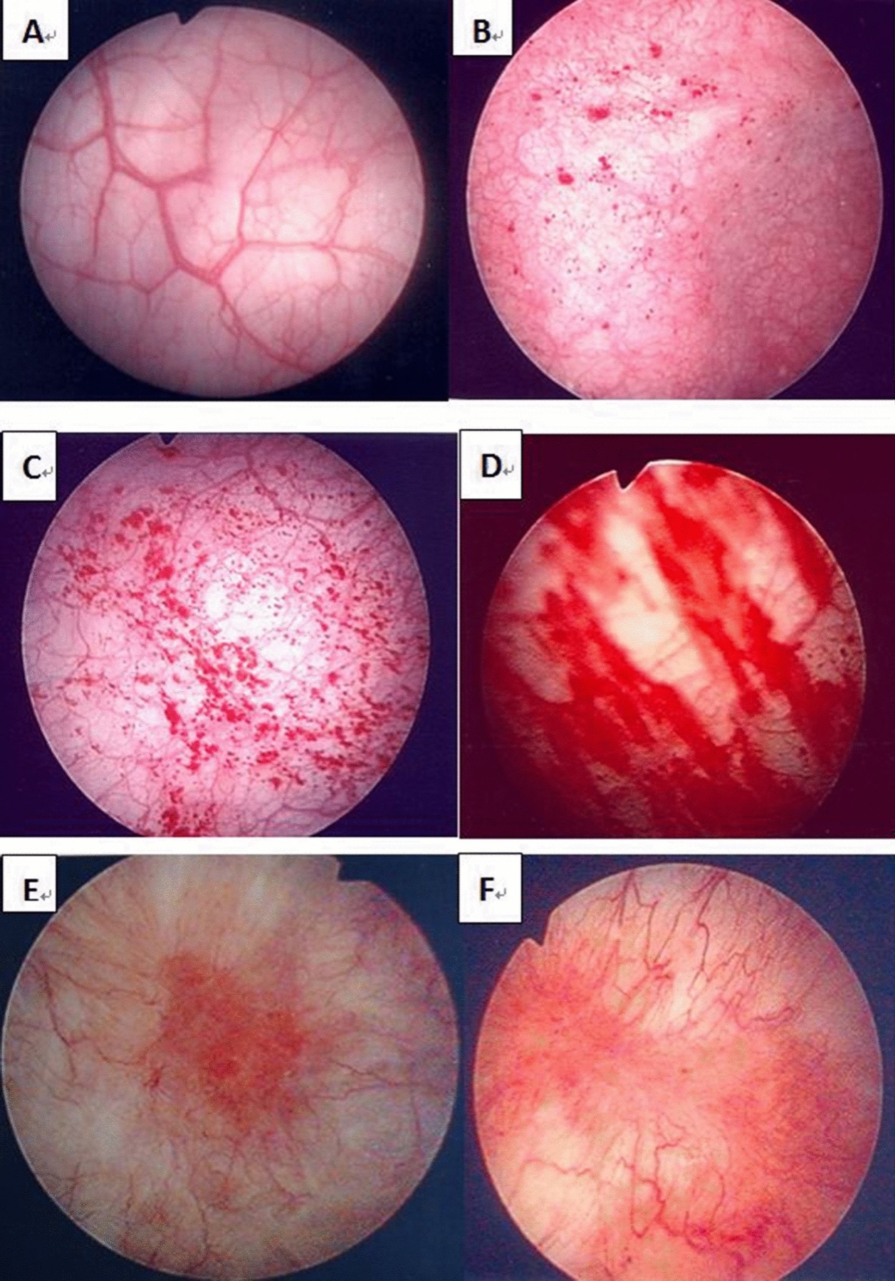Campo cistoscópico circular após hidrodistensão mostrando numerosos pontos hemorrágicos vermelhos, planos e disseminados por ampla área da mucosa vesical, compatíveis com glomerulações grau 2.
