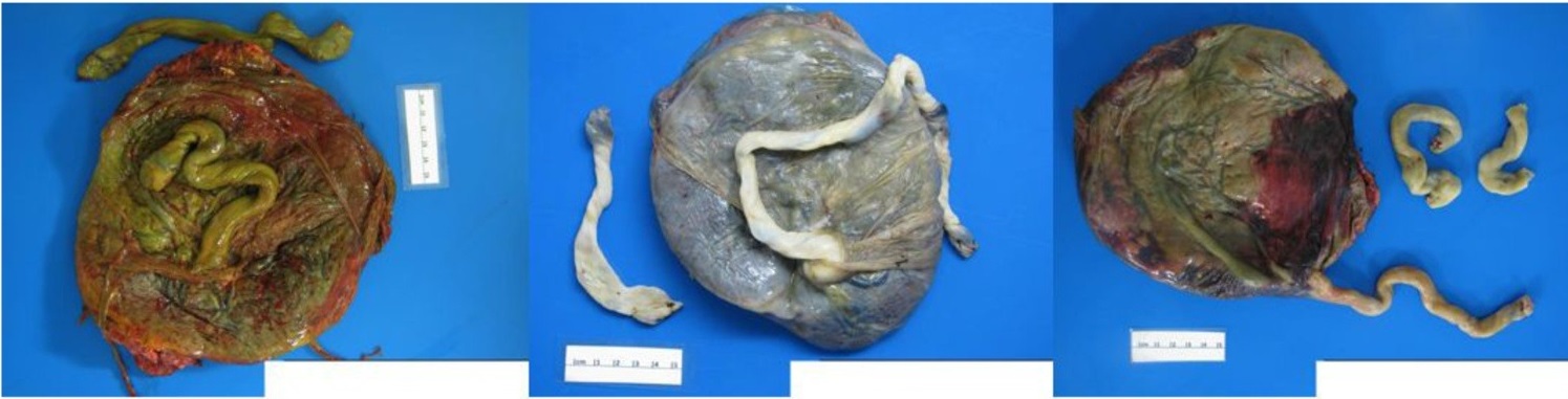 Tres placentas com impregnacao meconial: membranas e cordao tingidos de verde-acastanhado.