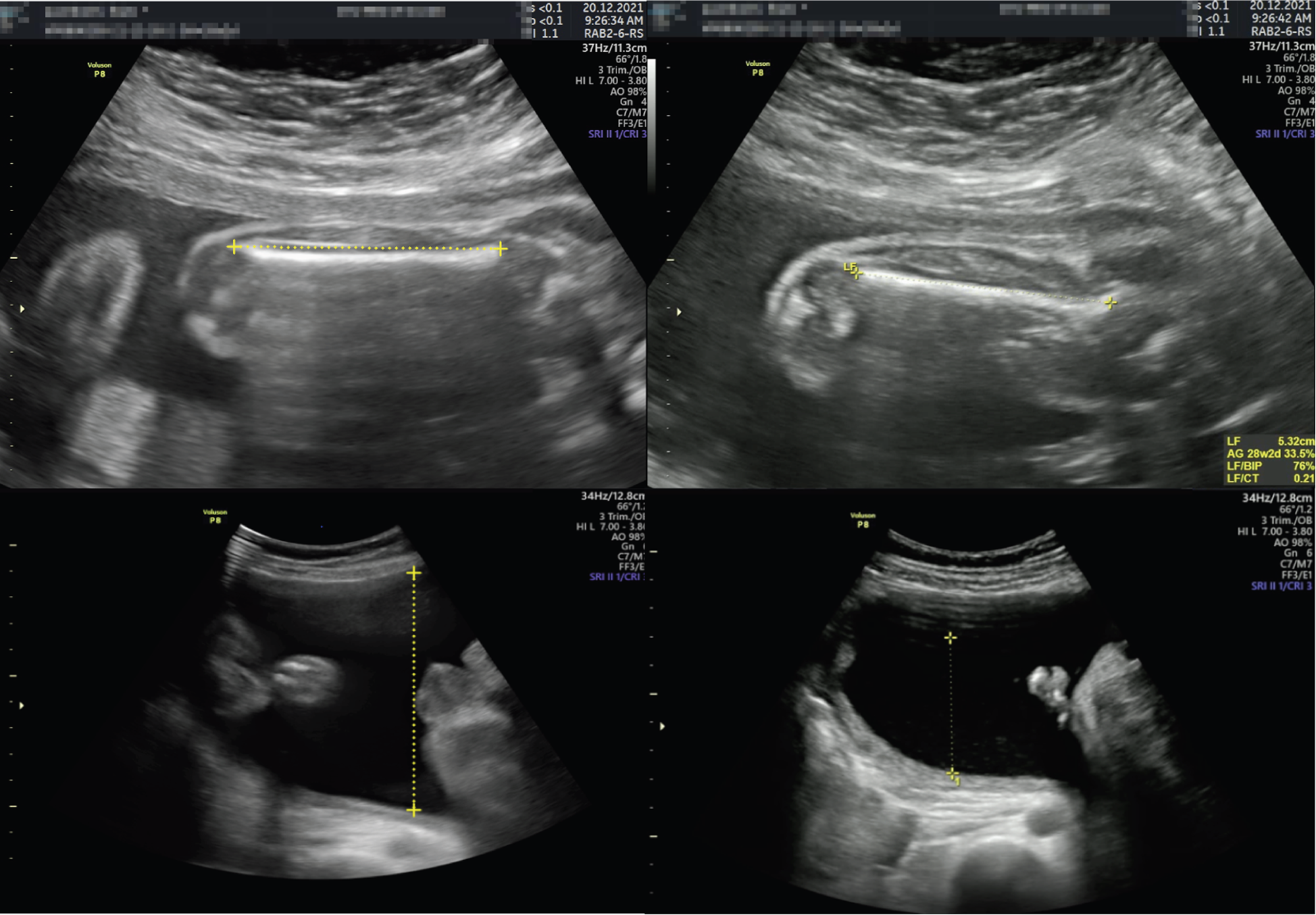 Ultrassom obstetrico mostrando a medida de um bolsao de liquido amniotico (VLA), parametro do perfil biofisico fetal.