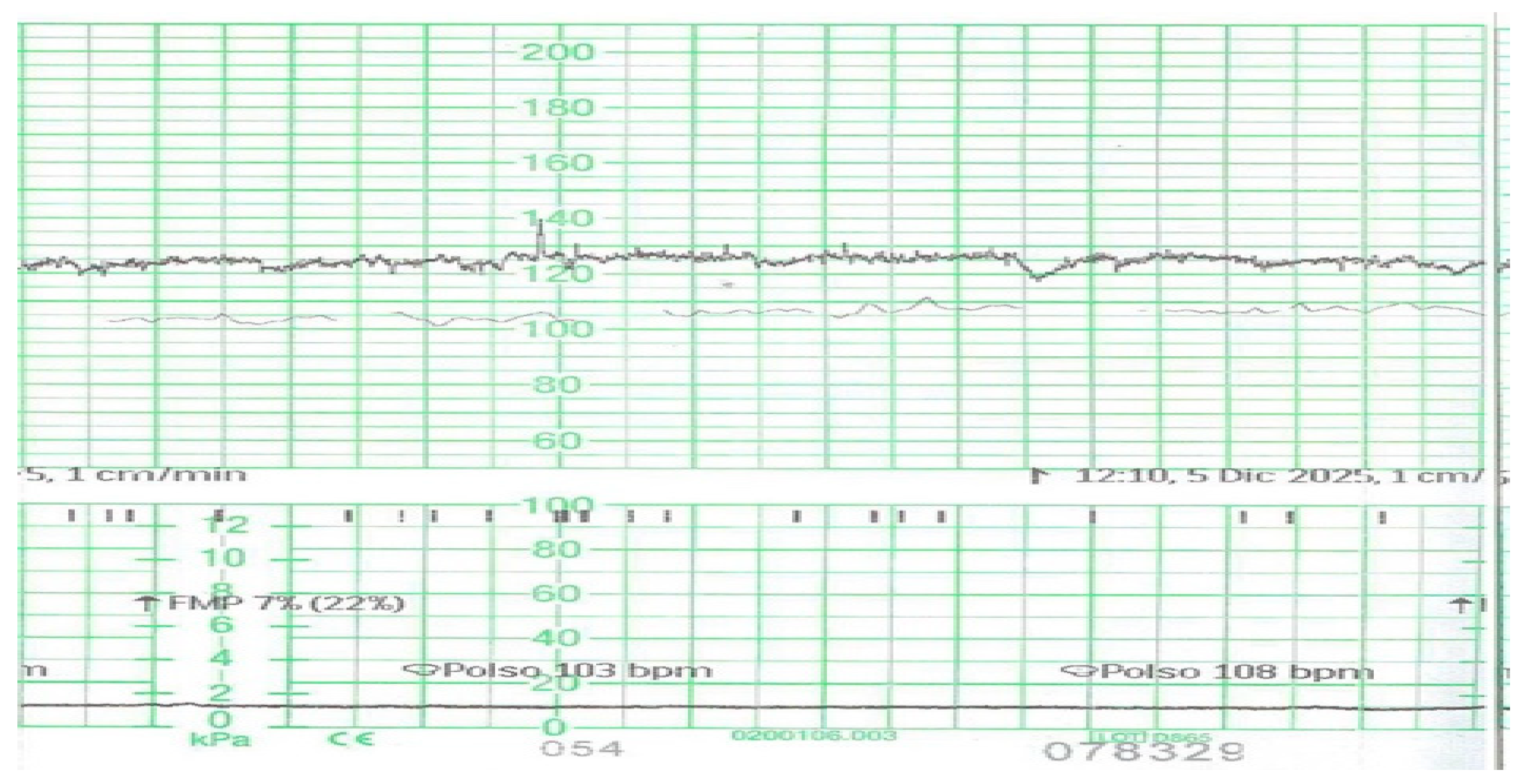 Tracado de cardiotocografia anteparto com o canal do tocografo sem contracoes, apenas a FCF registrada.
