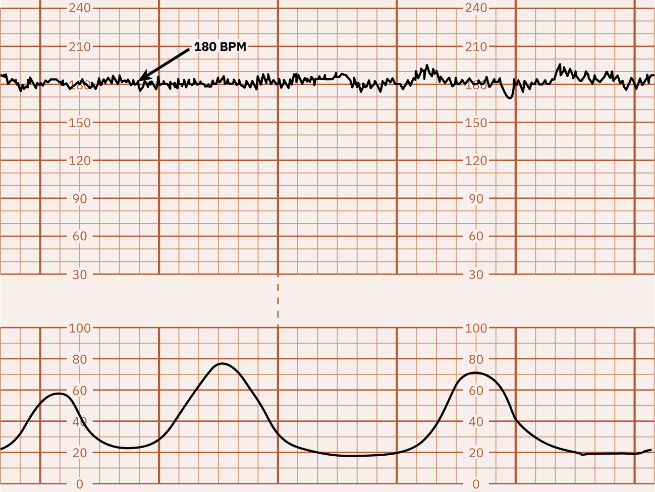Tracado com taquicardia sustentada em 180 bpm.