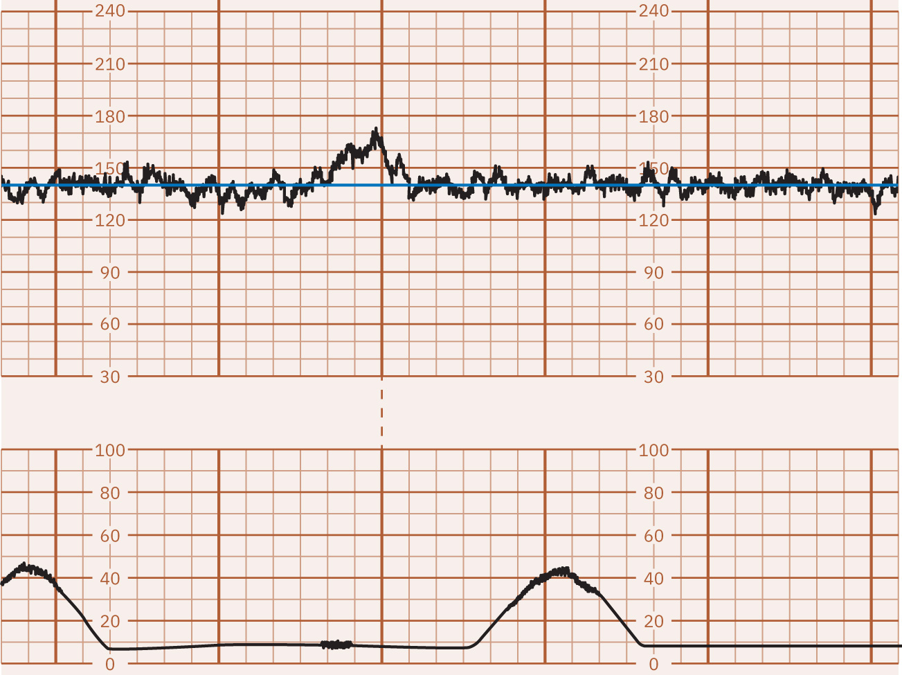 Tracado com linha de base normal em torno de 140 bpm.