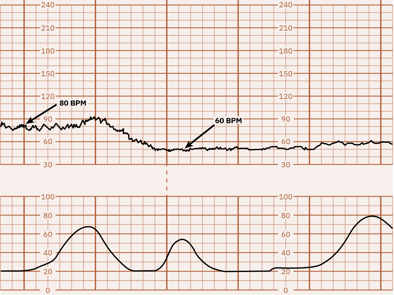 Tracado com bradicardia abaixo de 110 bpm.
