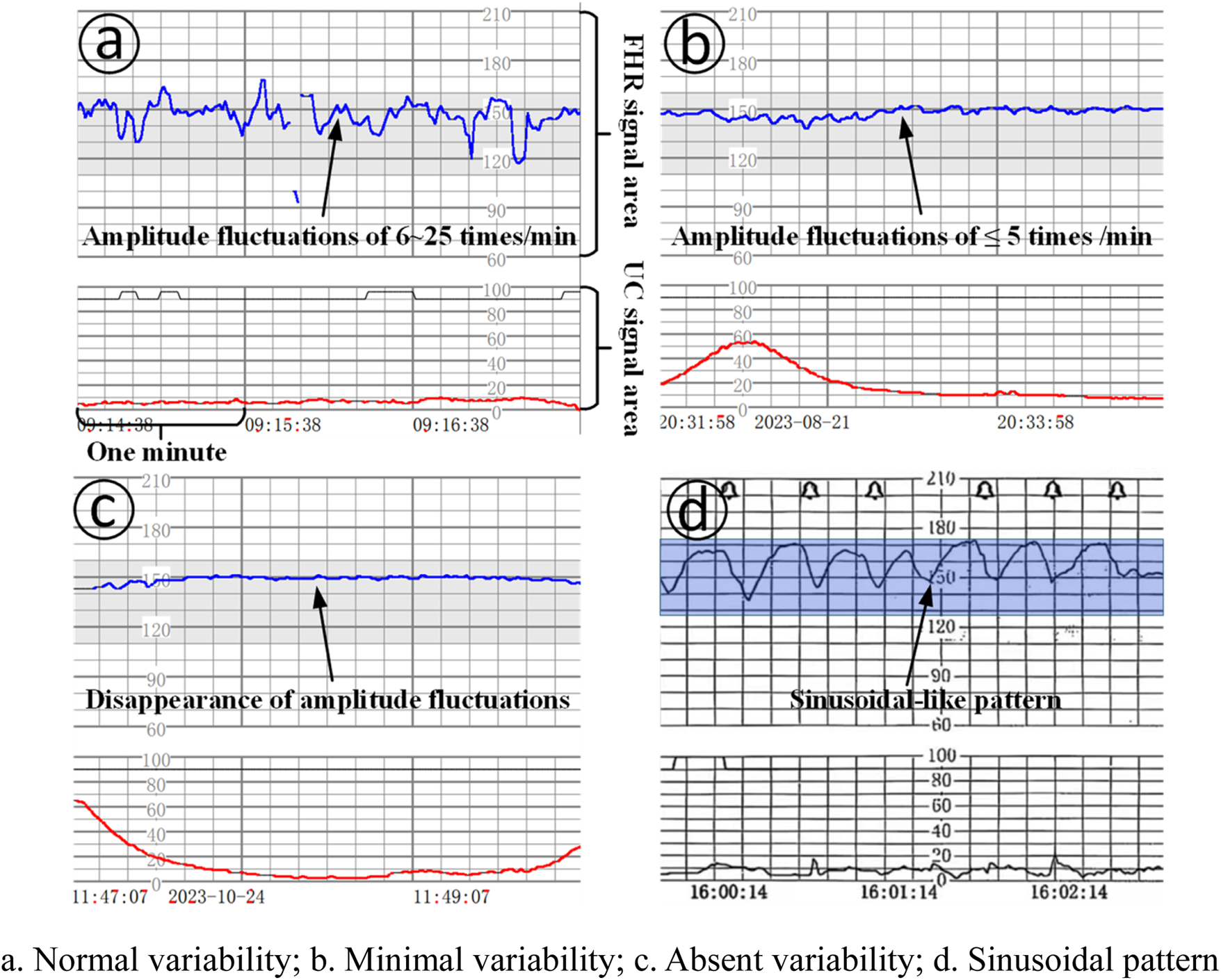 Tracado de cardiotocografia com padrao sinusoidal, ondas regulares e monotonas em serie, sugestivo de anemia fetal grave.