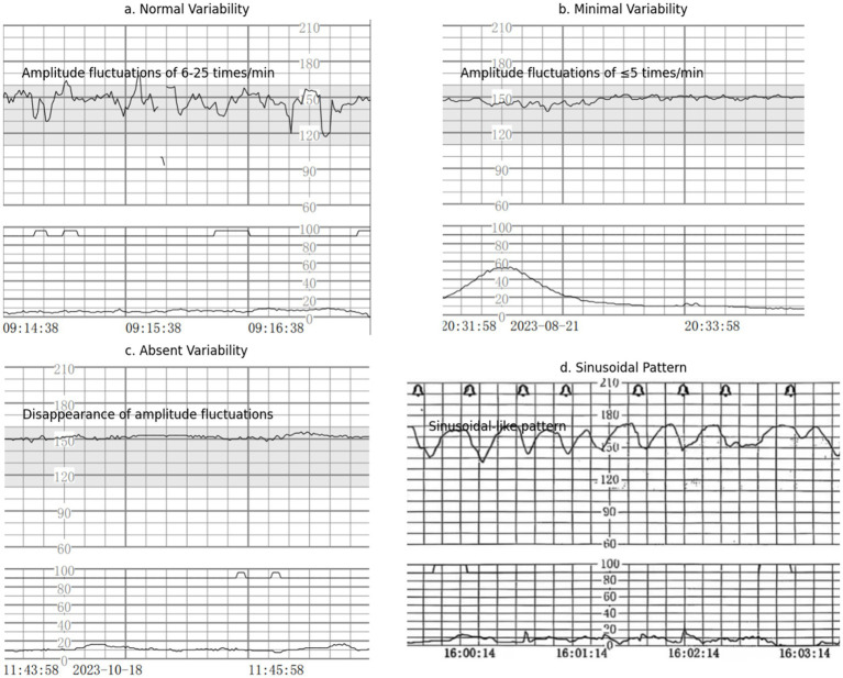 Tracado de cardiotocografia com perda de variabilidade, linha achatada e amplitude igual ou inferior a 5 batimentos.