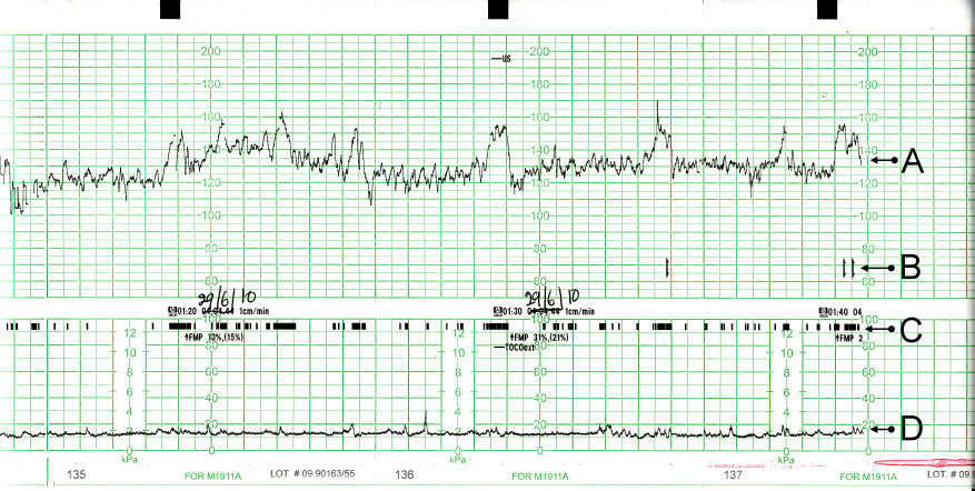Tracado de cardiotocografia com foco em acelerações da FCF de ao menos 15 bpm por ao menos 15 segundos, com retorno a linha de base.
