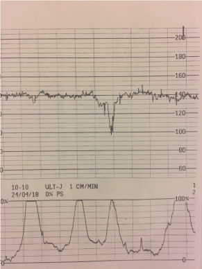 Tracado de cardiotocografia com DIP I: desaceleracao simetrica cujo vale coincide com o pico da contracao.