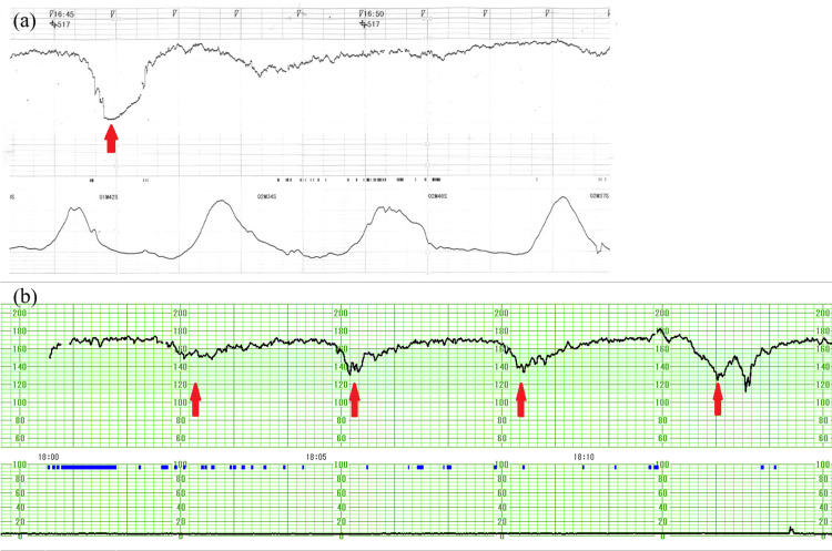 Tracado de cardiotocografia com DIP II: desaceleracao tardia cujo vale ocorre apos o pico da contracao.