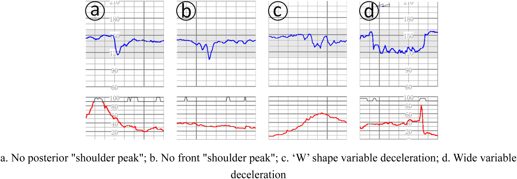 Tracado de cardiotocografia com DIP III variavel: desaceleracoes de formatos diferentes, incluindo padrao em W.