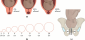 Esquema de descida da cabeça fetal em relação às espinhas isquiáticas: no plano 0 a apresentação atinge as espinhas (insinuada), acima é estação negativa, abaixo é positiva.