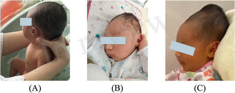 Céfalo-hematoma parietal em recém-nascido: abaulamento localizado do couro cabeludo que respeita os limites das suturas cranianas.