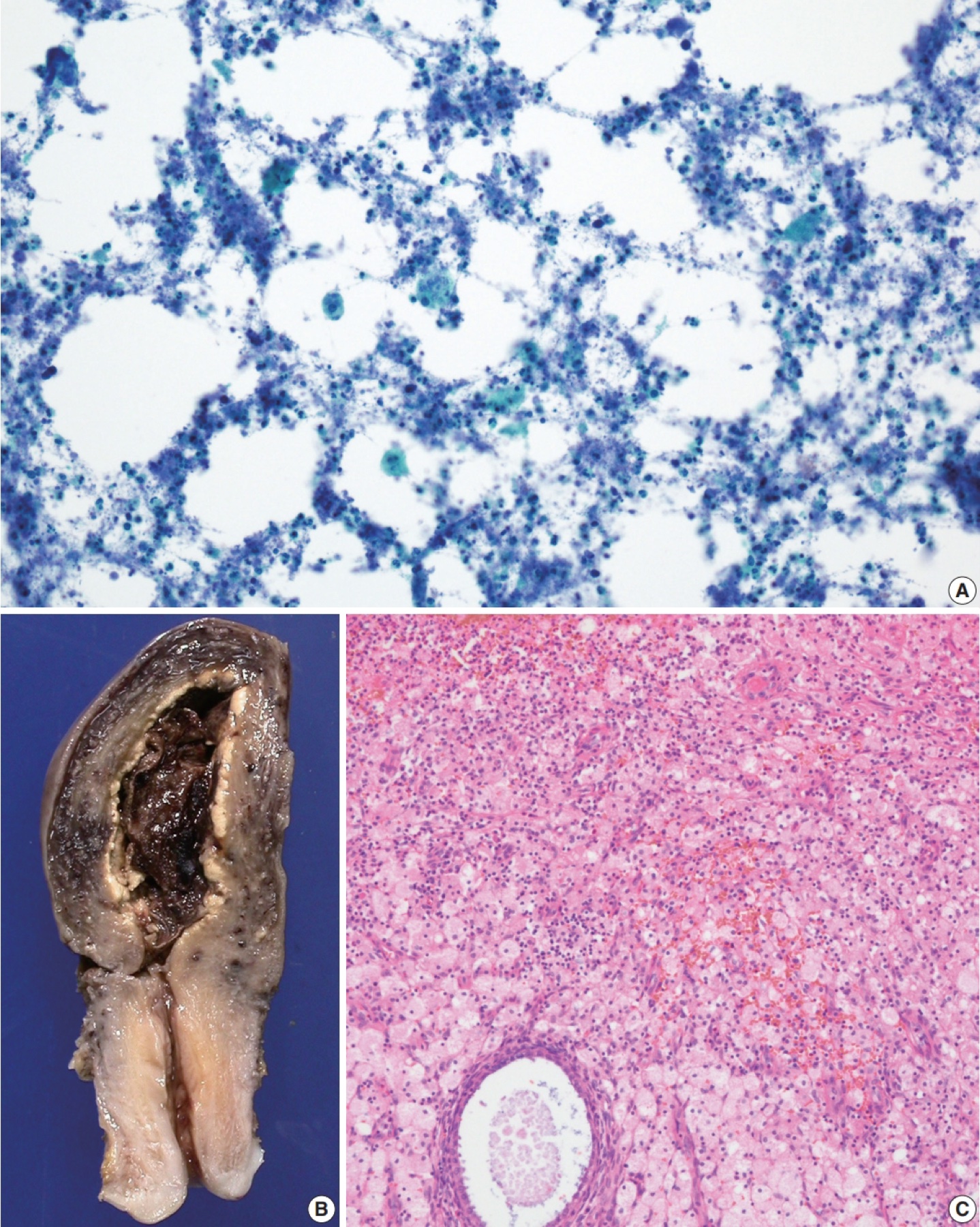 Histologia do endométrio com infiltrado inflamatório misto — substrato da endometrite.