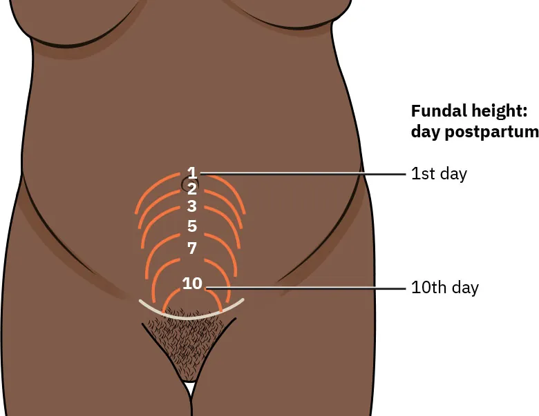 Esquema da involução uterina normal: o fundo descendo cerca de 1 cm por dia após o parto.