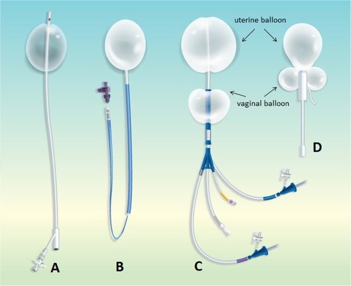 Balão de Bakri insuflado na cavidade uterina — tamponamento por compressão.