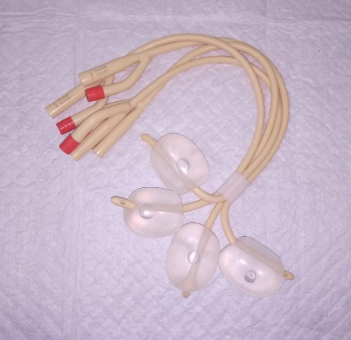 Sondas de Foley improvisadas como tamponamento intrauterino de recurso — balonetes insuflados.