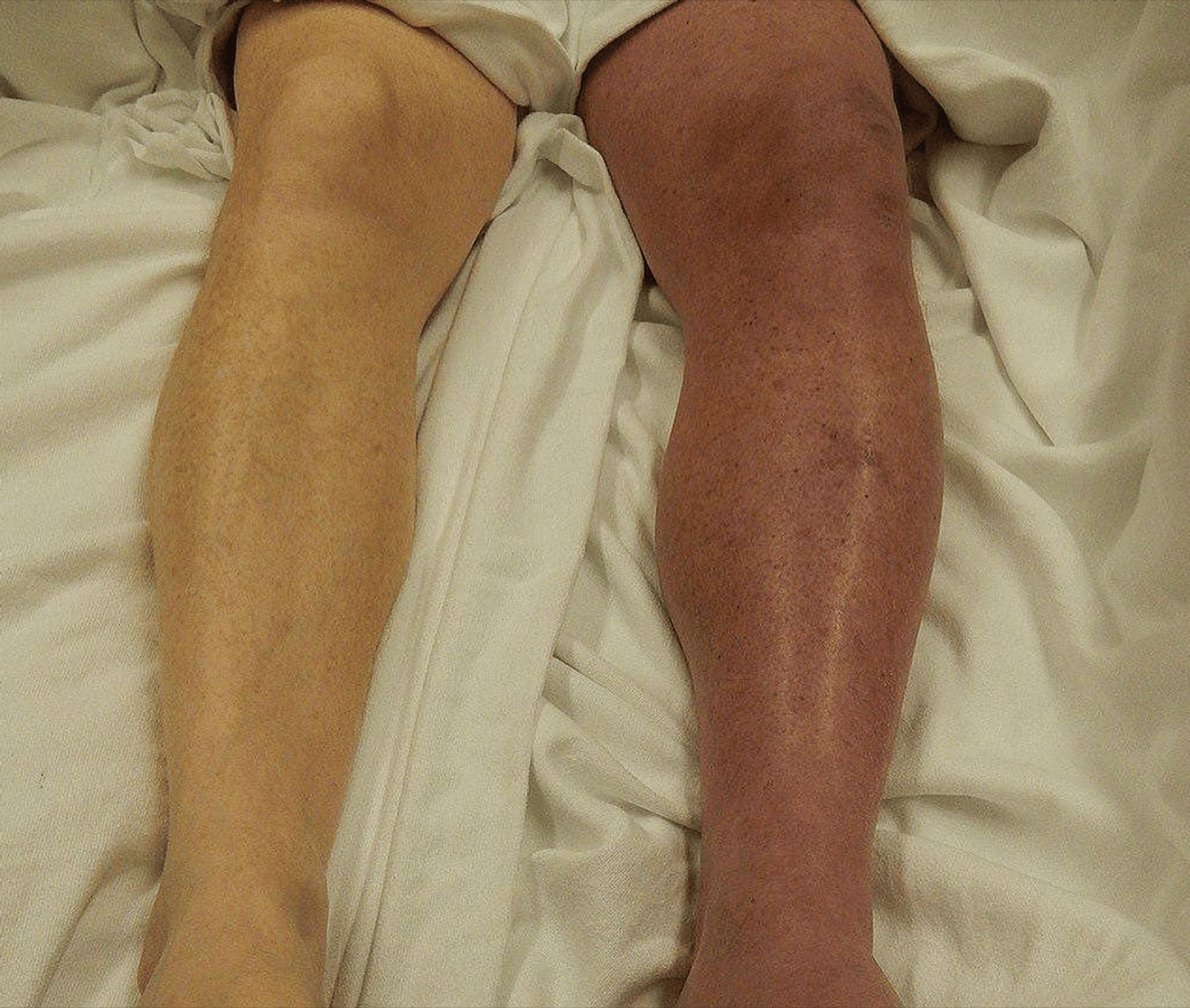 Comparação entre os membros inferiores mostrando panturrilha e coxa esquerdas mais volumosas, com edema e alteração de coloração — a assimetria unilateral que sugere TVP.