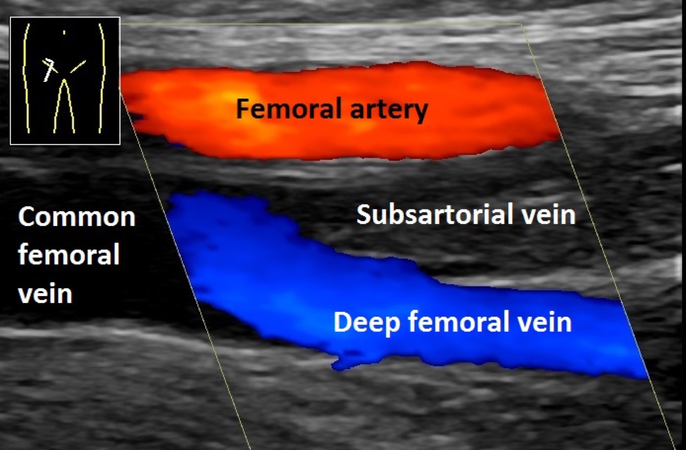 Ultrassonografia com Doppler colorido de membro inferior mostrando veia femoral preenchida por material ecogênico e sem fluxo — trombose venosa profunda.