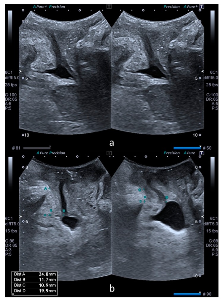 Ultrassonografia transperineal em repouso e ao Valsalva, com e sem cistocele, ilustrando a dinâmica do compartimento vaginal anterior.