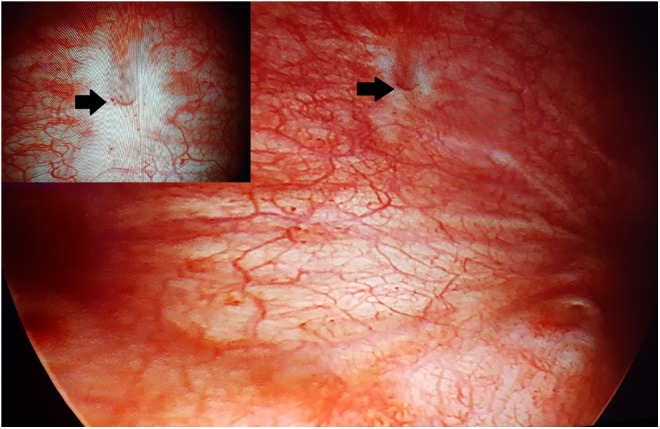 Visão intravesical por cistoscopia com setas indicando o pequeno orifício vesical de uma fístula vésico-vaginal, sem massa vegetante.