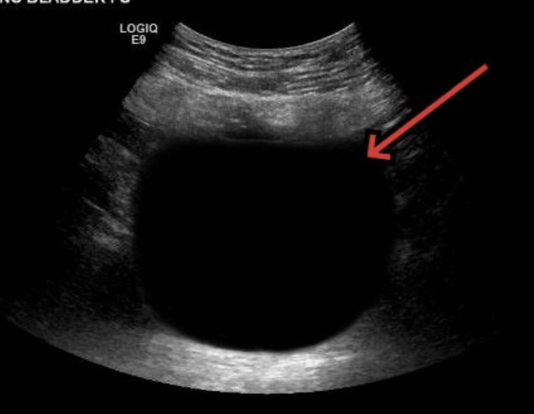 Ultrassonografia suprapúbica mostrando ampla estrutura anecoica arredondada e bem delimitada — bexiga muito distendida (globo vesical), estimada em 600 mL.