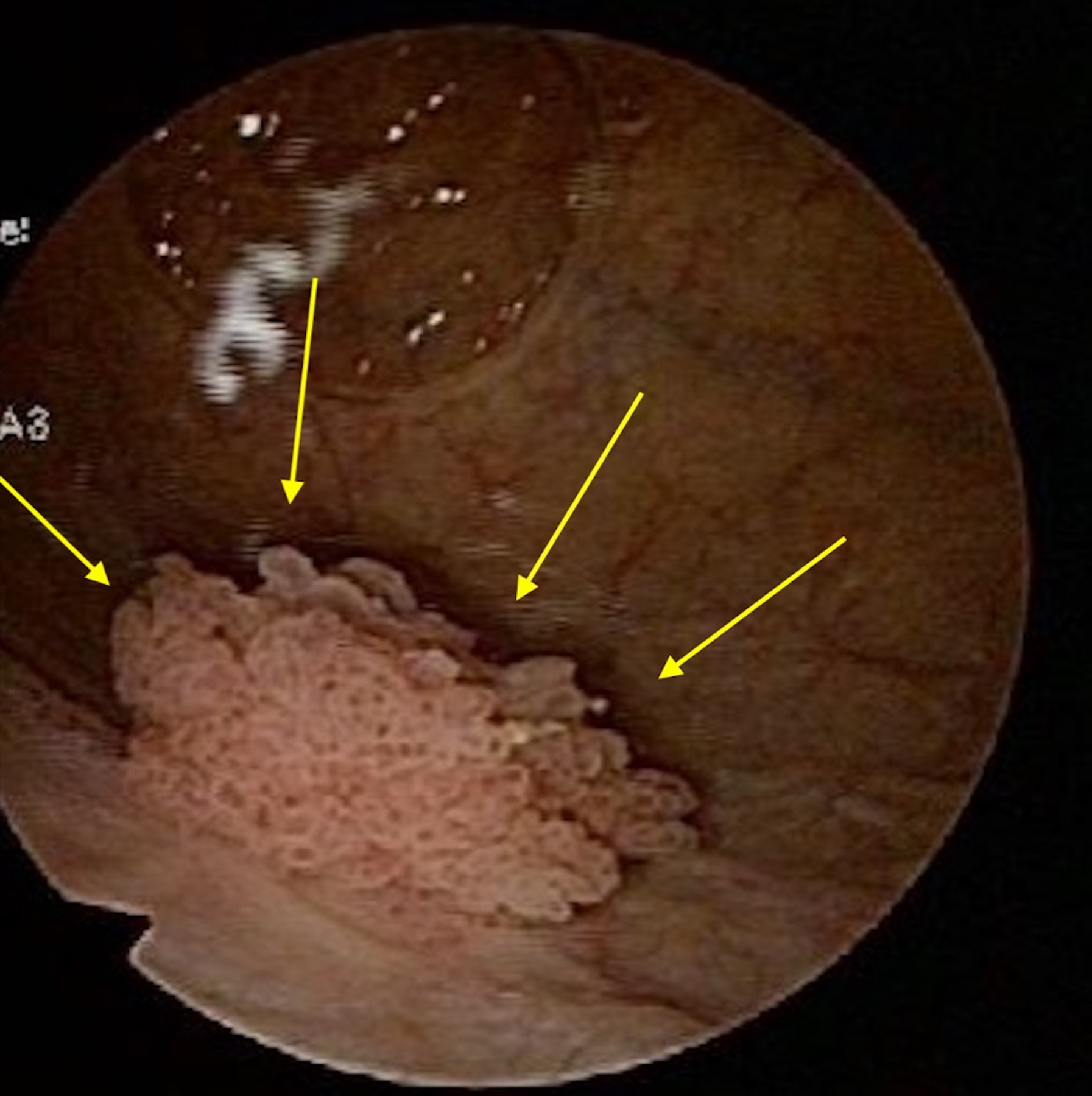 Cistoscopia mostrando massa papilífera intravesical de cerca de 2 cm, exofítica e irregular, delimitada por setas, projetando-se da parede posterior da bexiga.