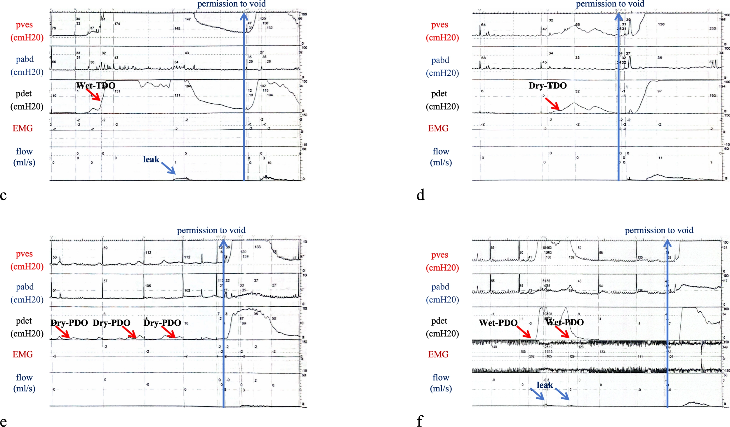 Traçado urodinâmico multicanal com pressão vesical, pressão abdominal, pressão detrusora, EMG e fluxo urinário, mostrando elevação da pressão detrusora sem aumento proporcional da abdominal e ponto de perda marcado.