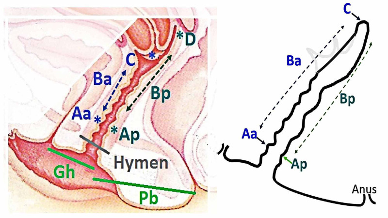 Diagrama de classificação POP-Q em dois painéis: corte sagital com os pontos referenciados ao plano do hímen e o esquema em linha das medidas.
